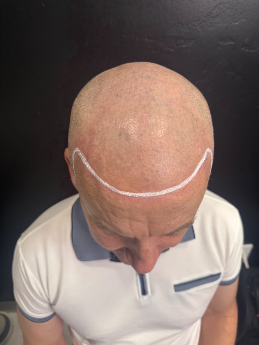 Client with hairline design drawn on, top view