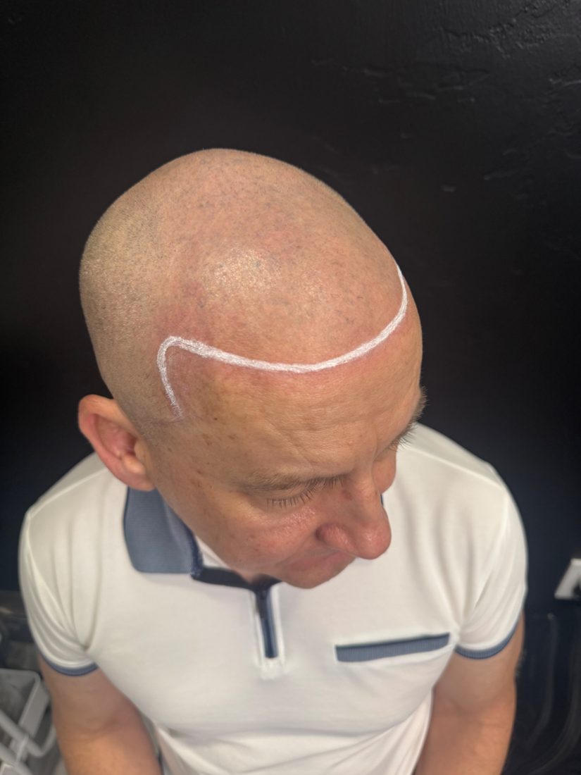 Hairline design, side view