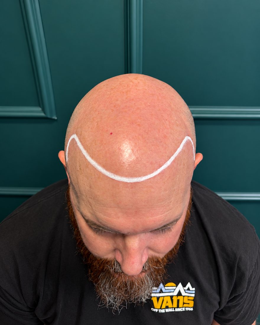 Same client before SMP, with hairline design drawn on
