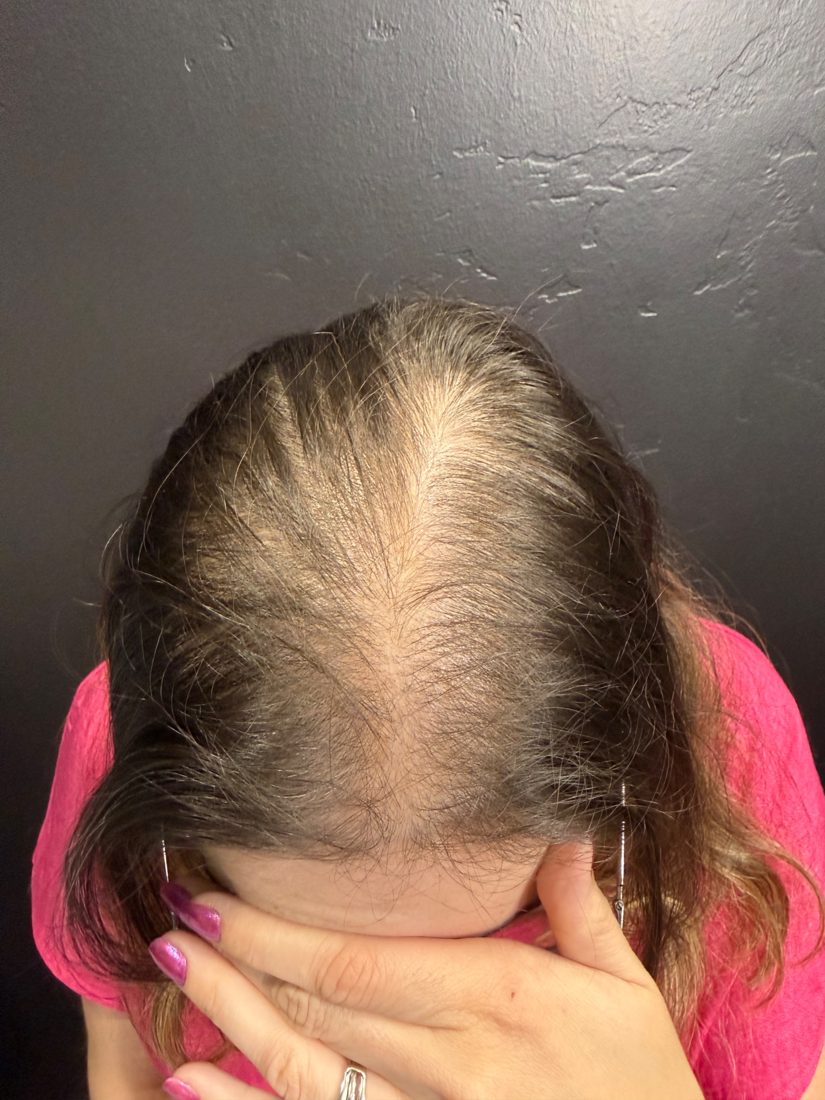 Woman covering her face, showing thinning at the part